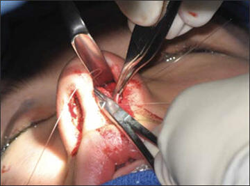 photo of suture stabilization of the spreader graft