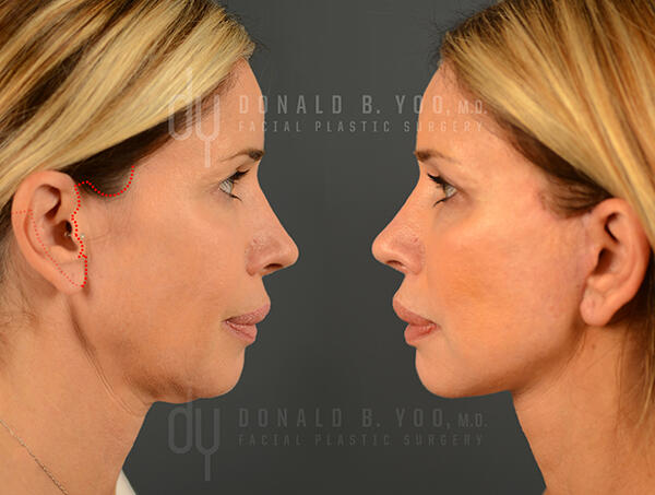 Facelift - Incision Before and After