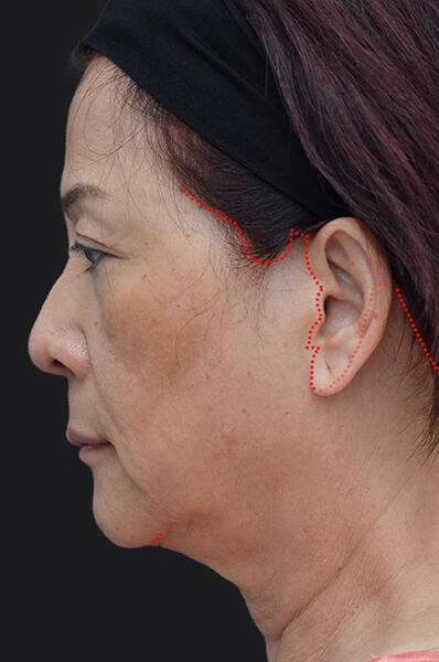 Facelift Incision - Before and After