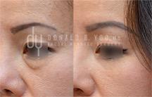 Lower Blepharoplasty surgical procedure (before and after)