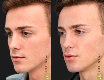 Microneedling Procedure (Before and After Oblique View)