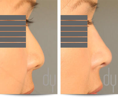 3rd Before and After Photo of Non Surgical Rhinoplasty Results