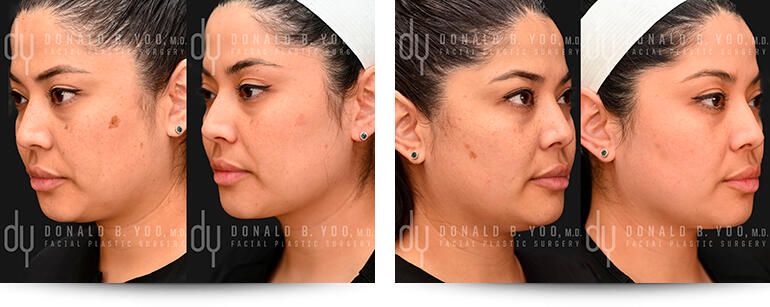 Picosure - Before and After Photo