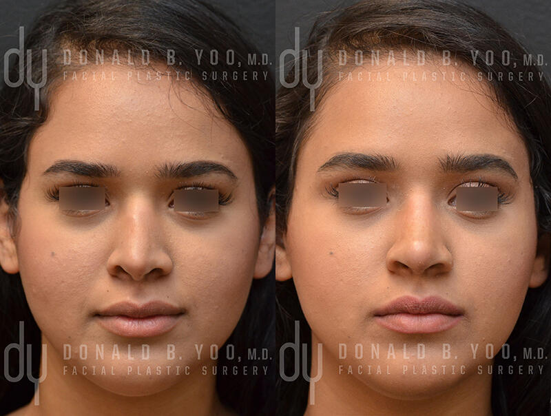 Revision Rhinoplasty Frontal View