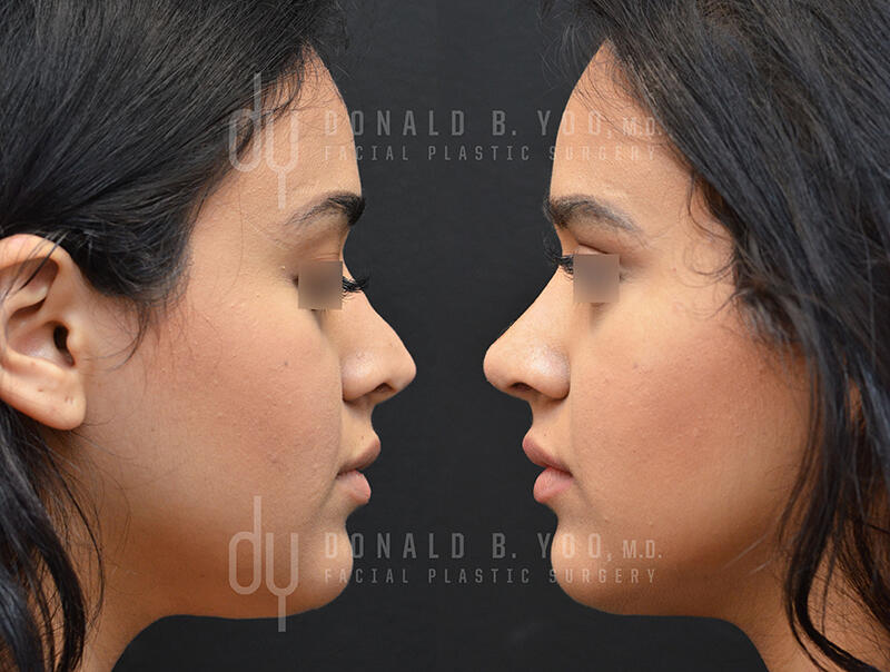 Revision Rhinoplasty Reflection View