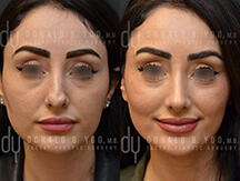 Revision Rhinoplasty Frontal View Before and After