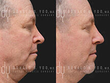 Revision Rhinoplasty Right Profile Before and After