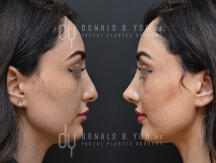 Rhinoplasty surgical procedure (before and after)