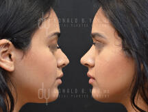 Before and after surgical Rhinoplasty