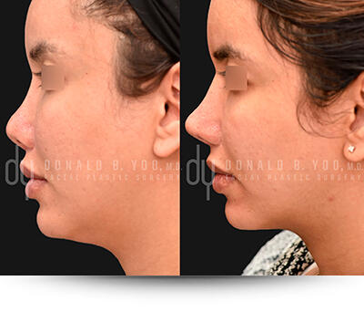 Submental Liposuction before and after