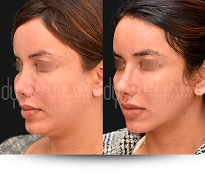 Before and after of Submental Liposuction