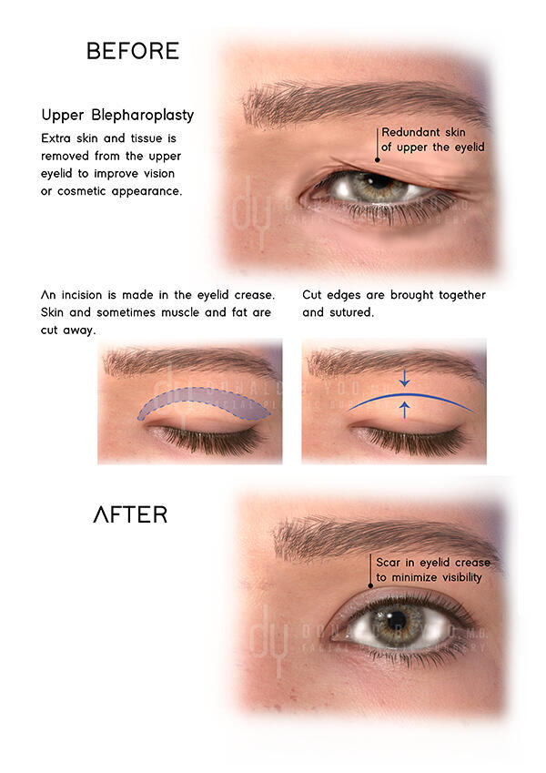 Traditional Upper Blepharoplasty